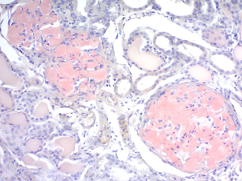 proteína β-amiloide