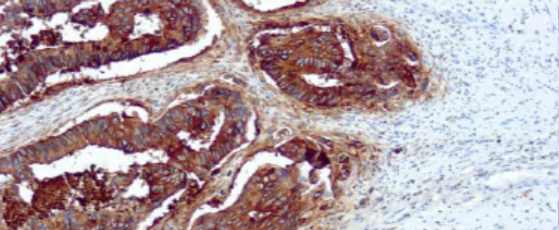 Antígeno Carcinoembrionario (CEA)