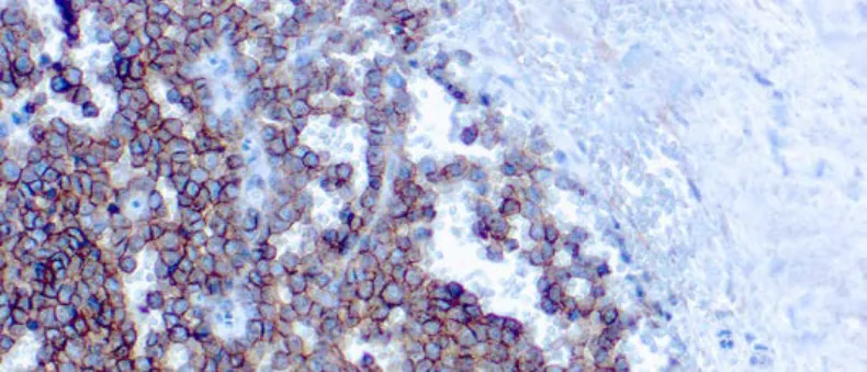 CD99/MIC2, Ewing’s Sarcoma Marker