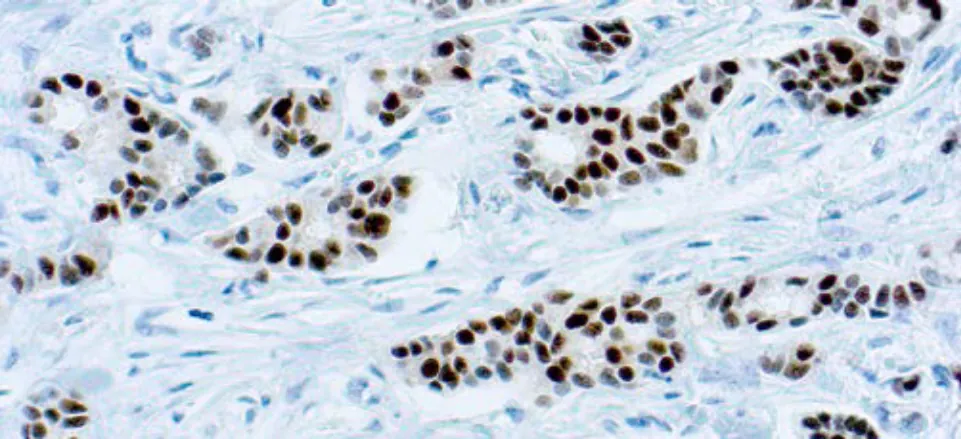 Estrogen Receptor (6F11)