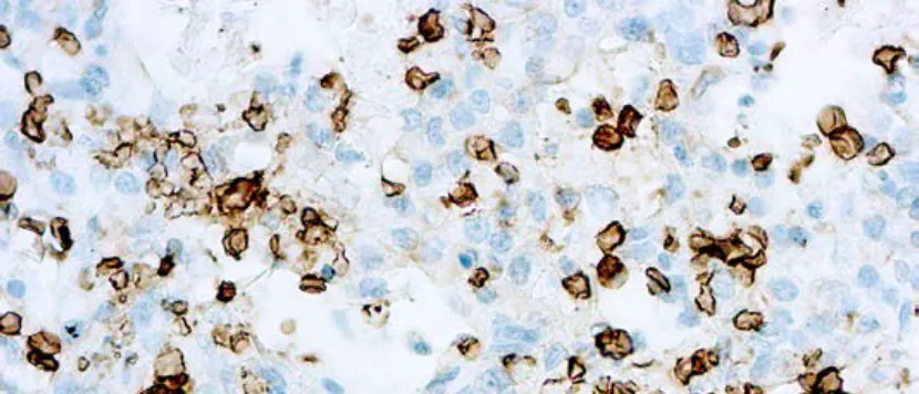 Panel Mesotelioma