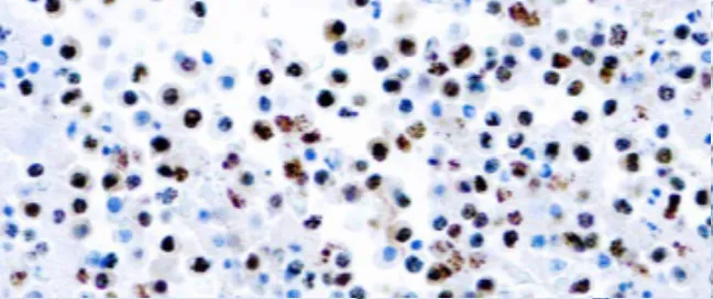 Herpesvirus 8 (HHV8)