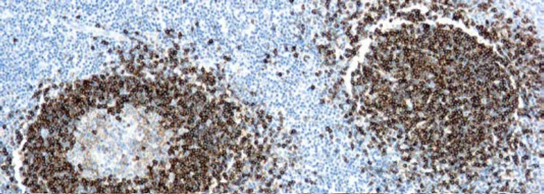 Leucemia de células peludas