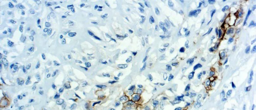 Mesothelin
