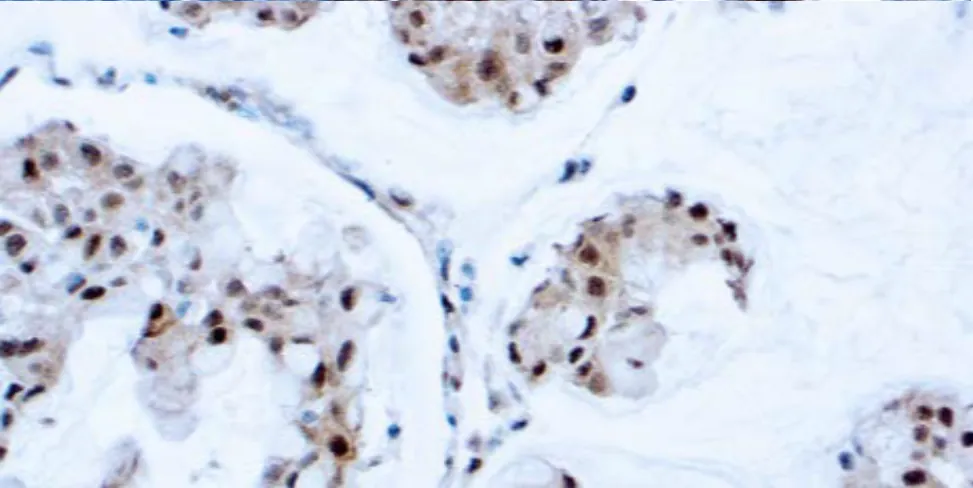 PTEN (Tumor Suppressor)