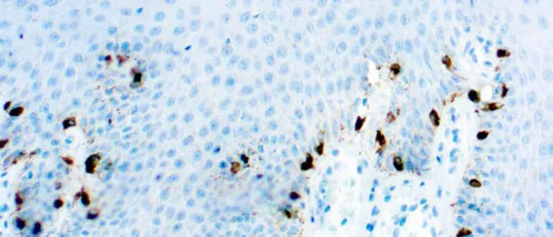 Tyrosinase, Melanoma Marker