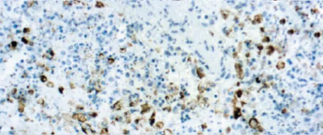 Virus del Herpes Simplex Tipo II (HSV2)